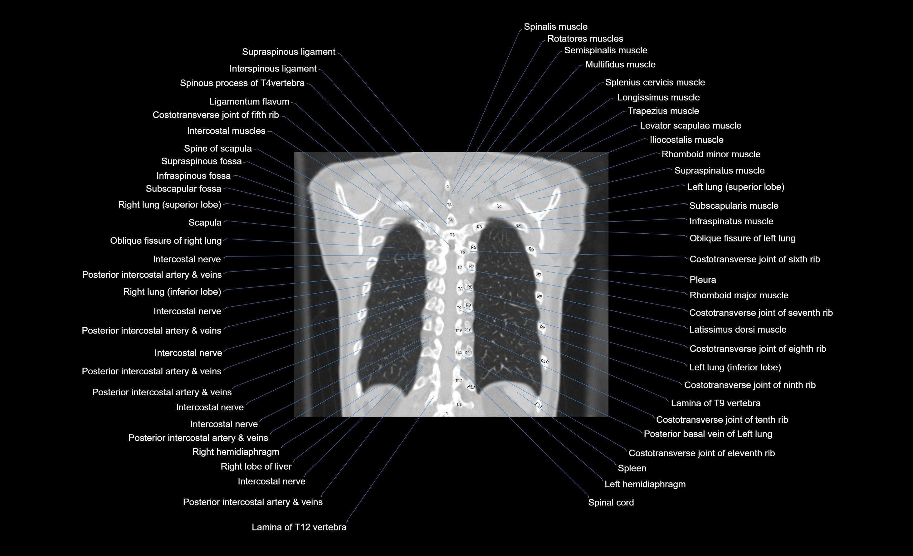CT chest (thorax) lung window window labelled coronal cross sectional anatomy radiology image-00024.webp
